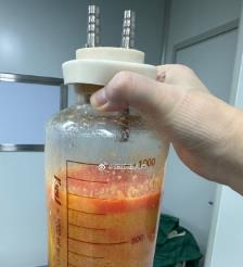 六安水动力吸脂手术要做多久？